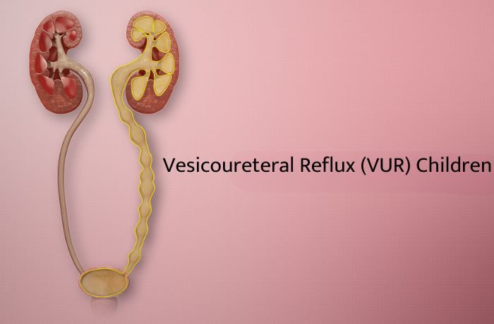 Vesicoureteral Reflux (VUR) Children