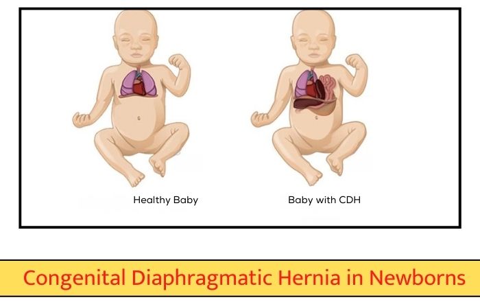 Congenital Diaphragmatic Hernia in Newborns