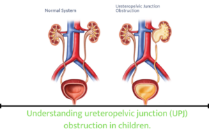 Understanding ureteropelvic junction (UPJ) obstruction in children.