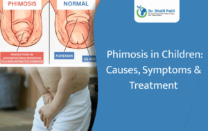 Phimosis in Children: Causes, Symptoms & Treatment