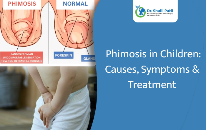 Phimosis in Children: Causes, Symptoms & Treatment